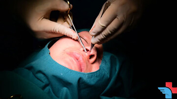 Nose surgery in Tehran - A dreamy nose job