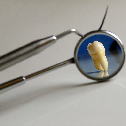 جراحی یک پدیده نادر؛ دندانی که داخل حفره بینی رشد کرده بود/ تصویر 