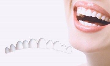 فرق لمینت، ونیر کامپوزیت و روکش دندان چیست؟