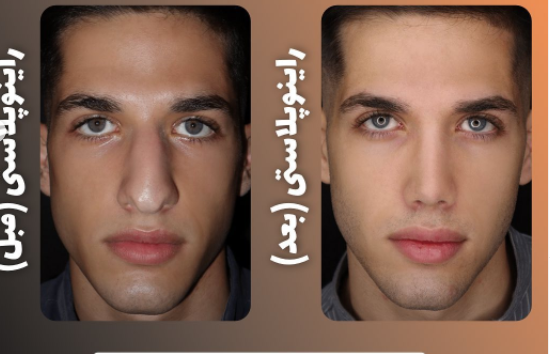 هزینه جراحی بینی در ایران