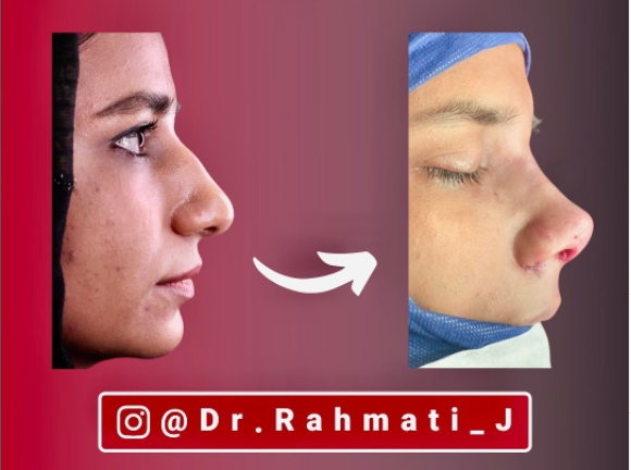 نمونه جراحی زیبایی بینی دکتر جواد رحمتی 