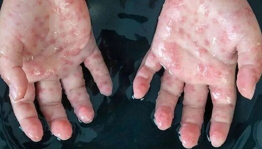 آبله میمون به امارات رسید آبله میمون به امارات رسید