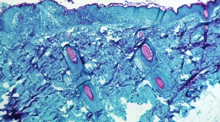 سازمان جهانی بهداشت با تایید ۱۰۰ مورد ابتلا به آبله میمون در اروپا، جلسه اضطراری تشکیل داد/ آنچه تاکنون میدانیم