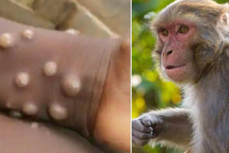  کدام واکسن‌ها می‌توانند مکانیزم دفاعی علیه آبله میمون داشته باشند؟