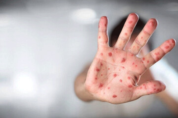 موذیگری تازه ویروس آبله میمونی موذیگری تازه ویروس آبله میمونی