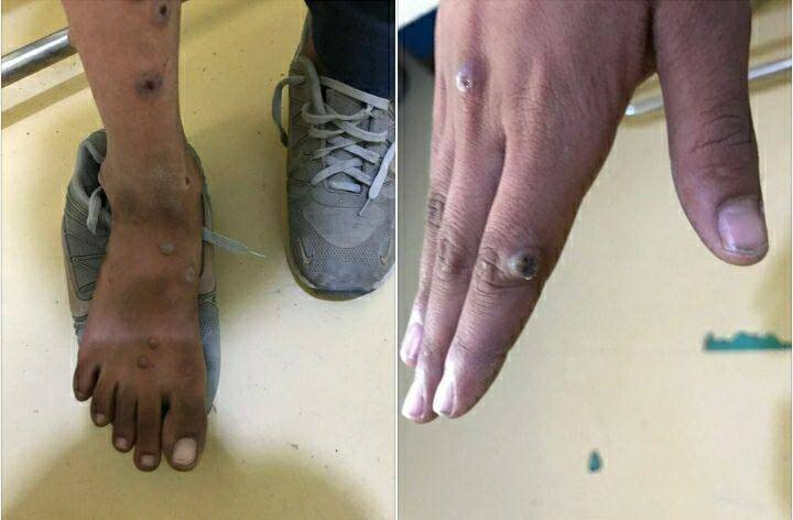 آبله میمون به همسایگی ایران رسید/ بیمار یک نوجوان دستفروش است/ عکس