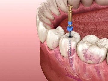 مراقبت از دندان عصب کشی شده چگونه است؟
