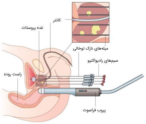 براکیتراپی؛ راهی برای درمان سرطان پروستات