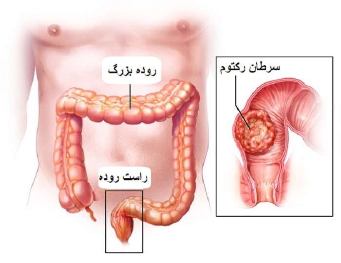 برای اولین بار در تاریخ؛ درمان همه بیماران سرطانی با یک دارو