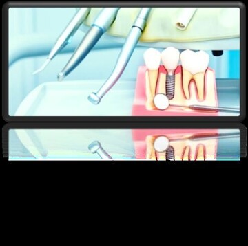 آشنایی با ایمپلنت دندان و کامپوزیت دندان آشنایی با ایمپلنت دندان و کامپوزیت دندان