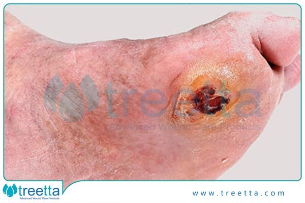 زخم پای دیابتی