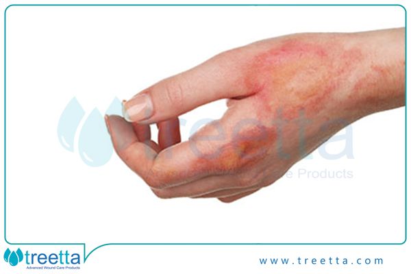 سوختگی درجه 2