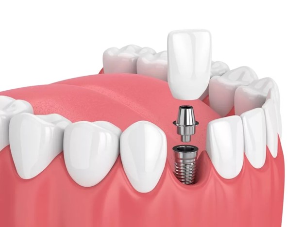 انواع ایمپلنت دندان، کدام روش برای شما مناسب تر است؟