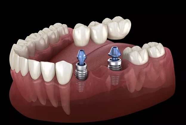 انواع ایمپلنت دندان، کدام روش برای شما مناسب تر است؟