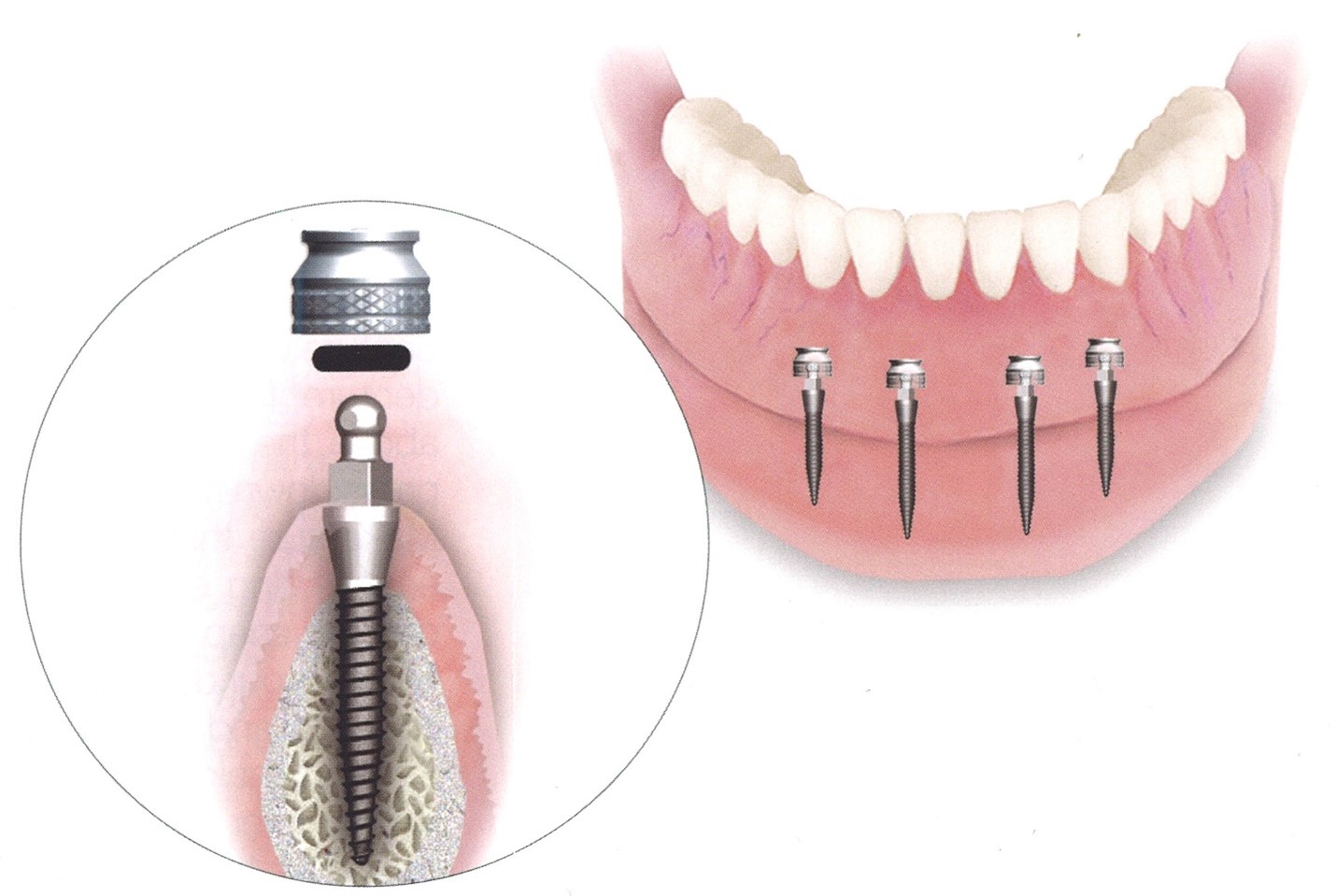 انواع ایمپلنت دندان، کدام روش برای شما مناسب تر است؟