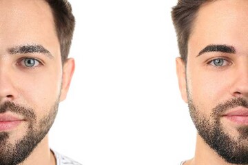 کاشت ابرو به روش FUT: مزایا و عوارض
