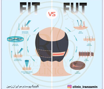کاشت مو به صورت اقساطی در کلینیک ایران زمین 