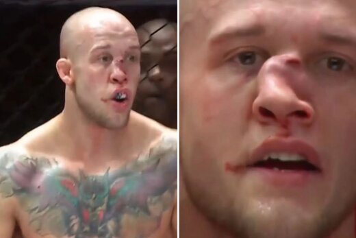 تصویر دلخراش از شکستگی بینی مبارز MMA/ عکس