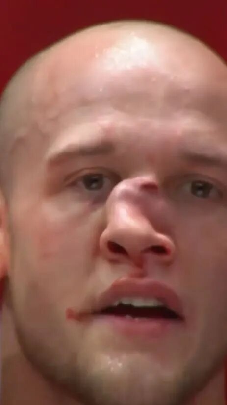 تصاویر وحشتناک از شکستگی بینی مبارز MMA