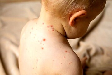 نشانه‌های آنفولانزای گوجه فرنگی را بشناسید