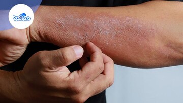 پمفیگوس فولیاسه چیست؟