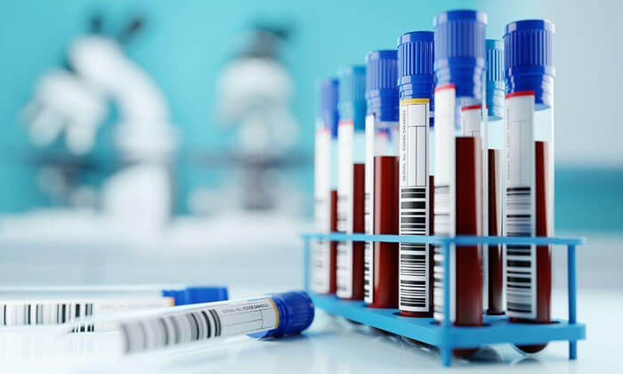 این گروه خونی زودتر سکته مغزی را تجربه میکنند