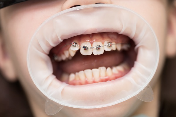 تبلیغات موثر برای متخصصین ایمپلنت و ارتودنسی در تهران چیست؟