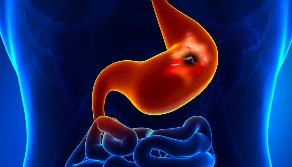 عوامل ایجاد زخمهای گوارشی را بشناسید/ روشهای کنترل کردن زخم معده