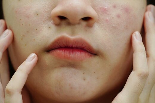 ملاک انتخاب کرم ضد آفتاب و کرم ضد لک در سال ۱۴۰۱