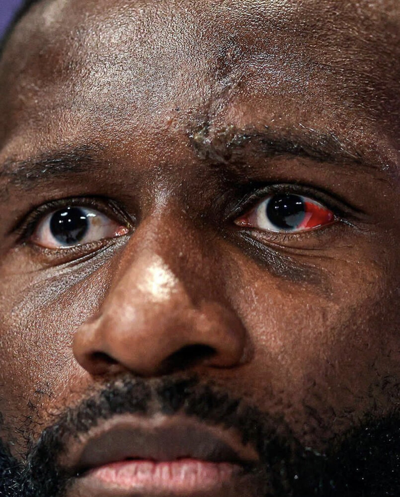 عکس| چشم خونی جنگجوی آلمانی پس از برخورد وحشتناک