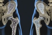 ۸ عامل اصلی که باعث پوکی استخوان می‌شود/ توصیه‌ها مهم برای جلوگیری از این بیماری