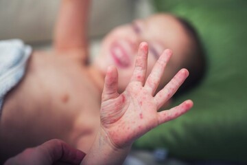 بیماری نادر «دست،پا و دهان» در کودکان چیست؟