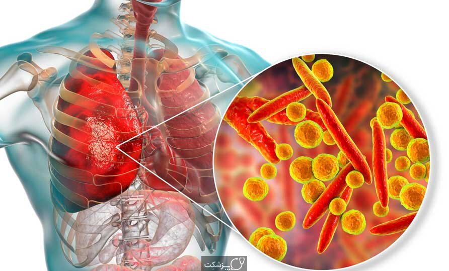 هشت بیماری تنفسی که زمستان را سختتر میکند؛ از سرماخوردگی تا انسداد ریه