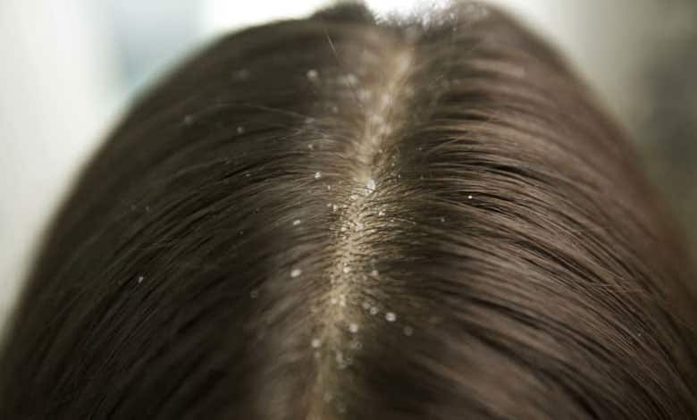 اگر شوره سر دارید بدنتان نیاز فوری به این ویتامین دارد