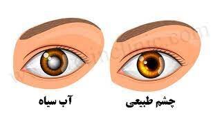 مراقب آب سیاه باشید/ فشار چشم چگونه به وجود میآید؟