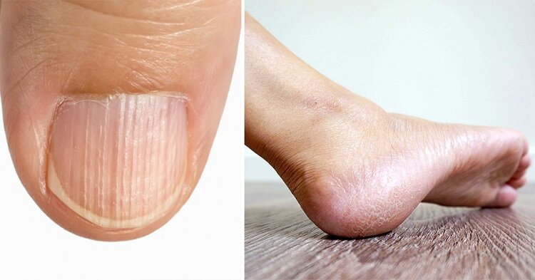 تغییر شکل ناخنها نشانه چیست؟/ هشداری که باید جدی گرفت