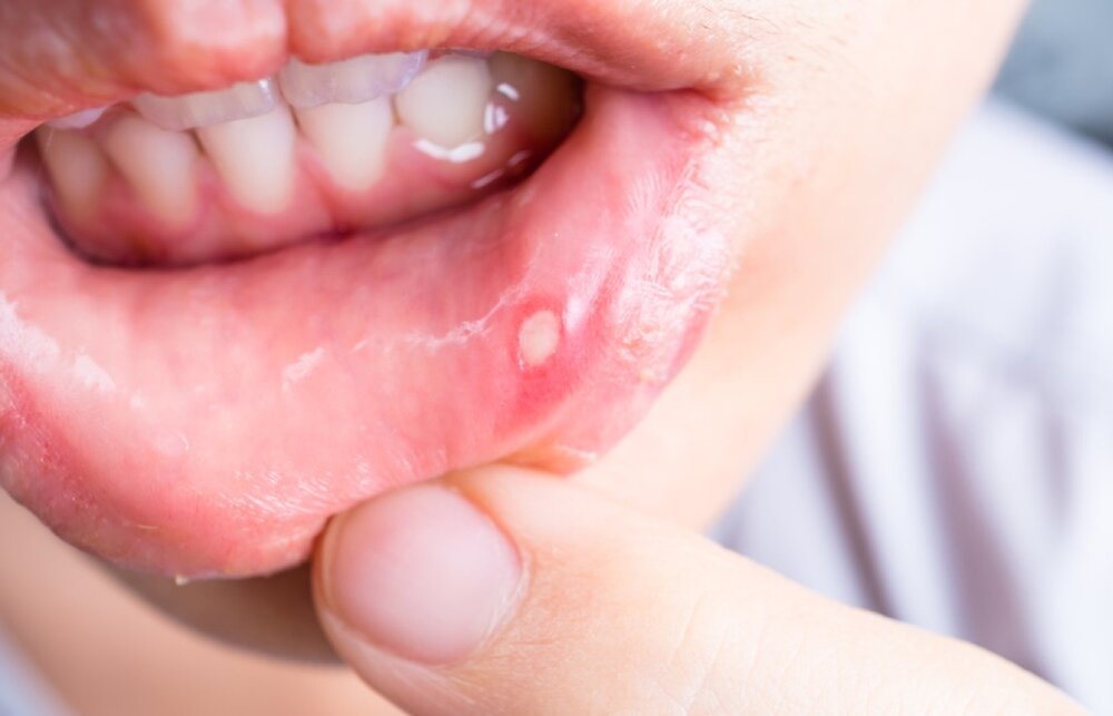 علت اصلی آفت‌های دهان چیست؟ / نحوه درمان آن