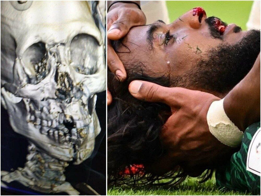 عکس | تصویر دردناک از جمجمه شکسته مدافع عربستان