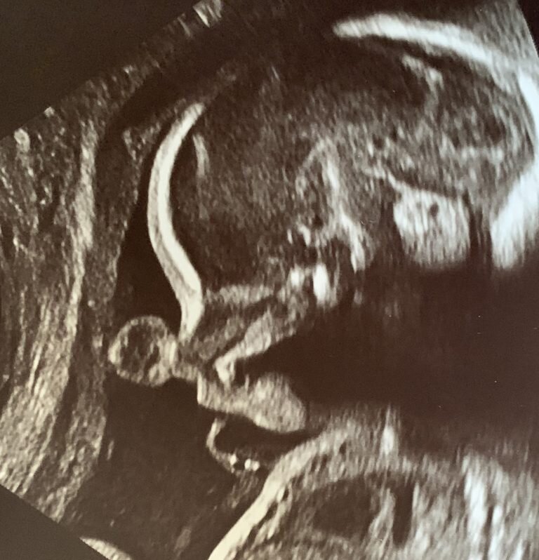 ارتباط عجیب بارداری و دندانها در انسانها