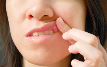 علت اصلی آفت‌های دهان چیست؟ / نحوه درمان آن