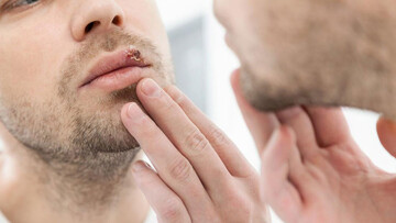 تبخالهای خطرناک کدامند؟ تبخالهای خطرناک کدامند؟