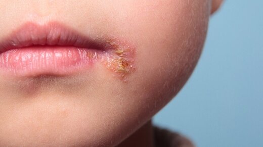 علائم و راههای درمان تبخال چیست؟ علائم و راههای درمان تبخال چیست؟