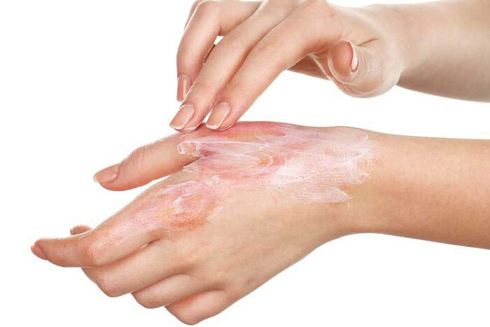 چند ترفند ساده برای درمان سوختگی؛ با این لبنیات سوزش پوست را تسکین دهید