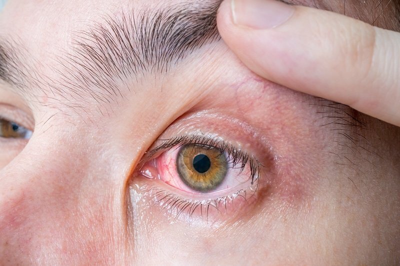 اگر قرمزی چشم دارید، چه زمانی باید به چشم پزشک مراجعه کنید؟ - خبرآنلاین