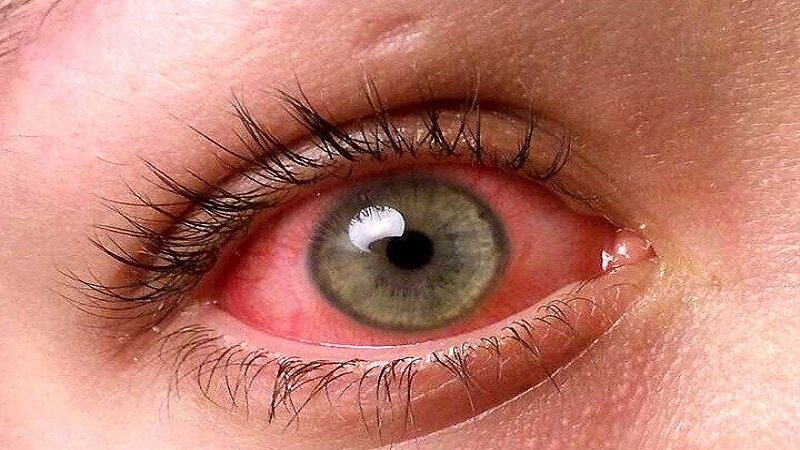 اگر قرمزی چشم دارید، چه زمانی باید به چشم پزشک مراجعه کنید؟ - خبرآنلاین