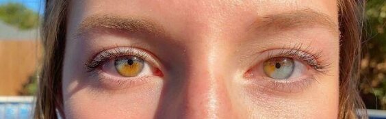 عکس | زیبایی خیرهکننده تیپهای ژنتیکی نادر در انسان