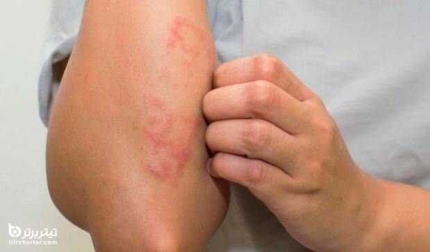 ۹ عارضه مهم مصرف سیگار بر پوست و مو