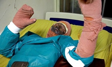 درمان هر یک درصد سوختگی ۱۰ میلیون تومان! درمان هر یک درصد سوختگی ۱۰ میلیون تومان!