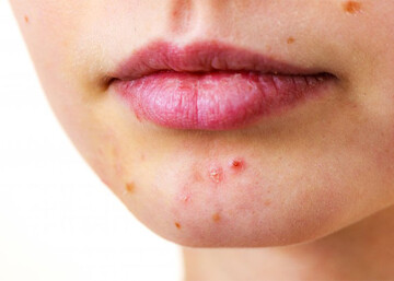 کدام جوشها دردناک هستند؟ کدام جوشها دردناک هستند؟