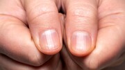 تشخیص کدام سرطان از روی ناخن‌ها امکان‌پذیر است؟
